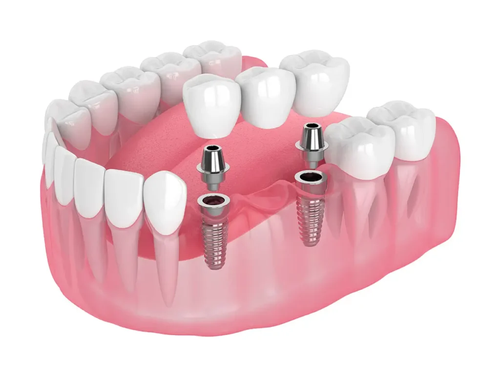 Dental implants bridge