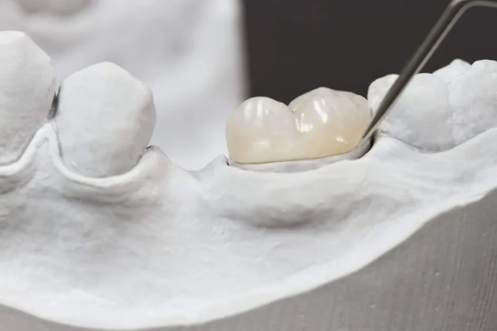 Dental crowns in spain