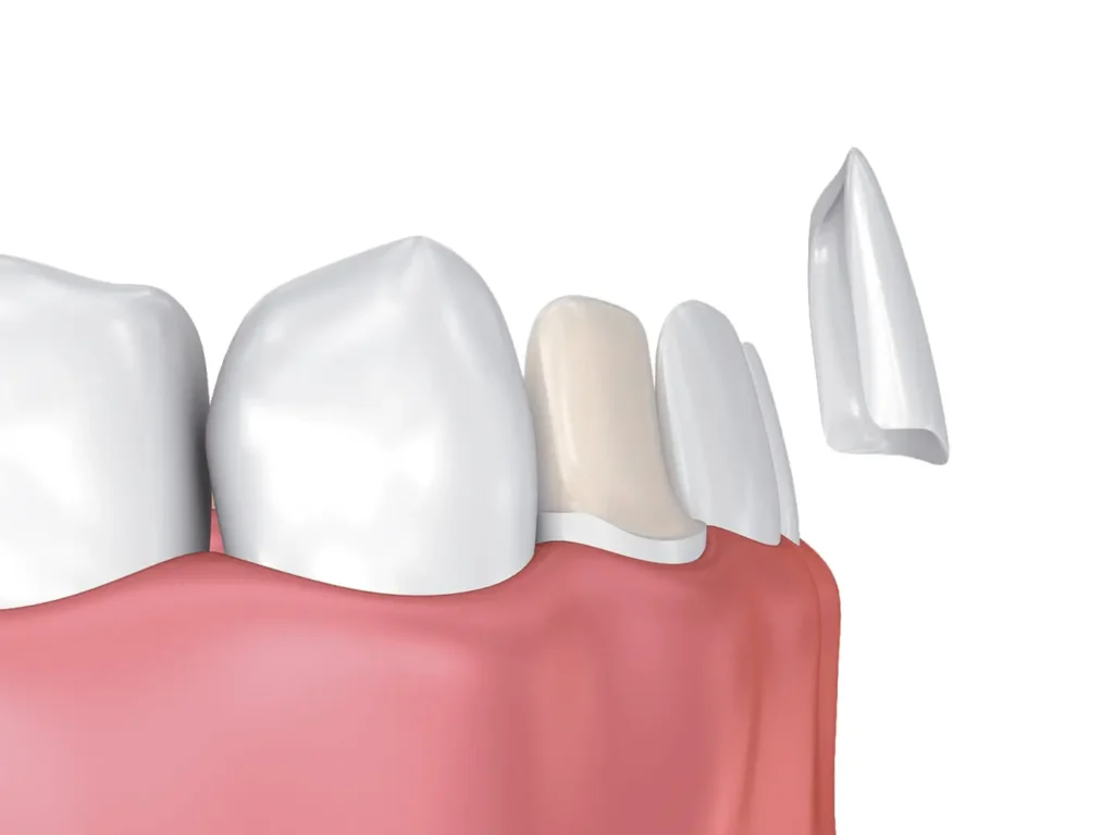 ceramic veneers in spain