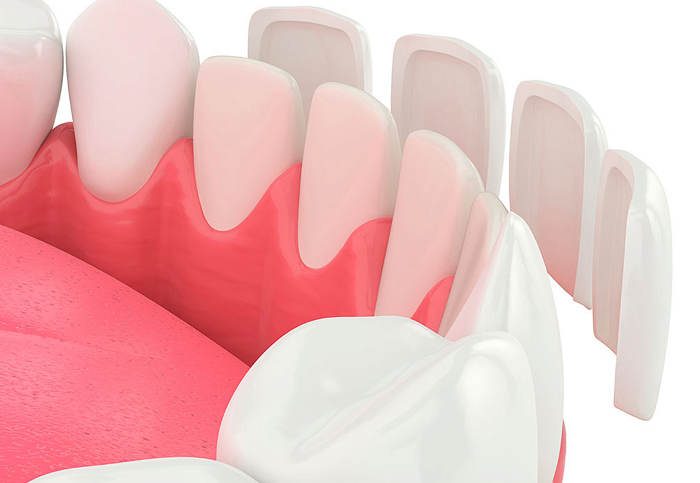 Zirconia veneers in spain