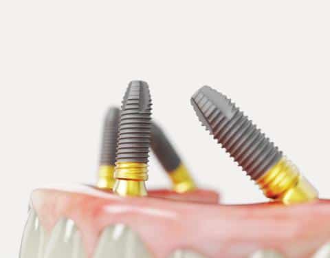 Dental implants nobel spain