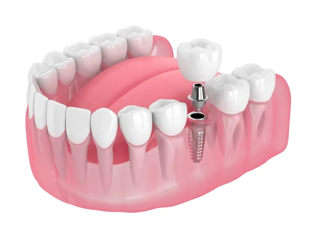 Dental implants spain